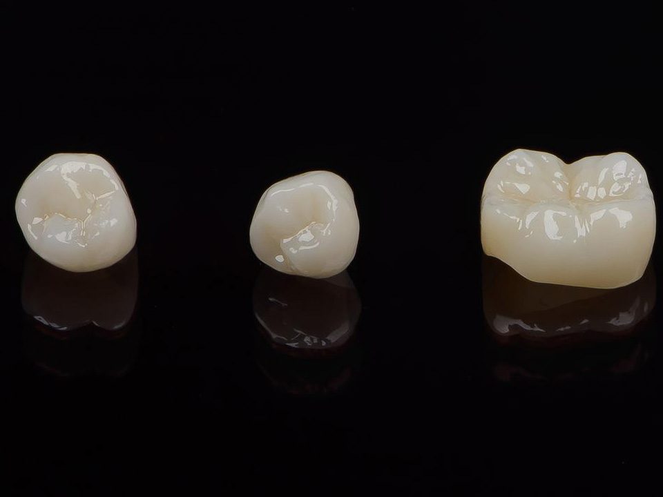 How Long do Porcelain Dental Crowns Last?