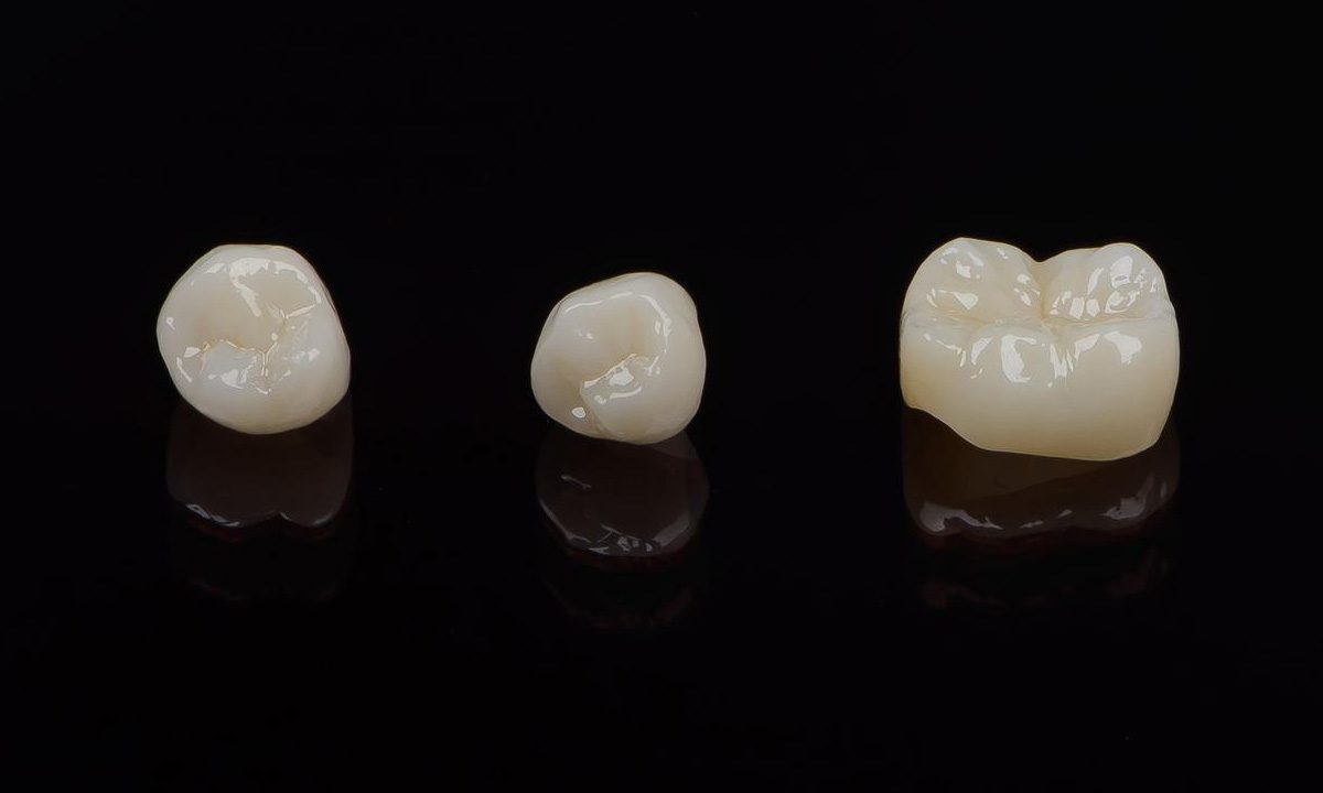 How Long do Porcelain Dental Crowns Last?