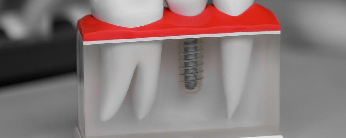 Can a Single Tooth Implant Be Done in One Day?
