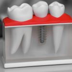 Can a Single Tooth Implant Be Done in One Day?