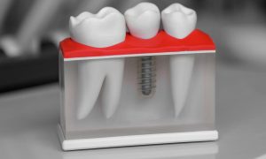 Can a Single Tooth Implant Be Done in One Day?