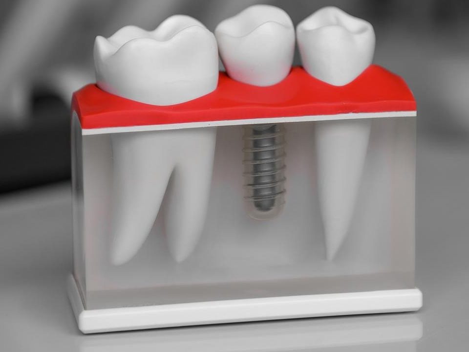 Can a Single Tooth Implant Be Done in One Day?