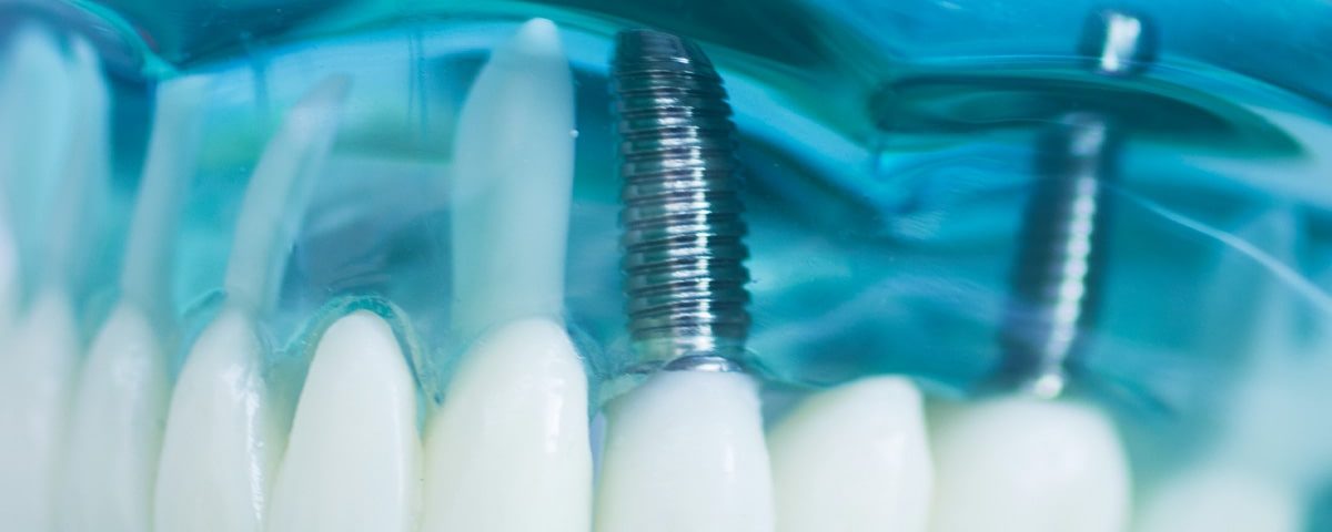 What Are Mini Dental Implants