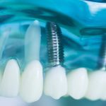 What Are Mini Dental Implants