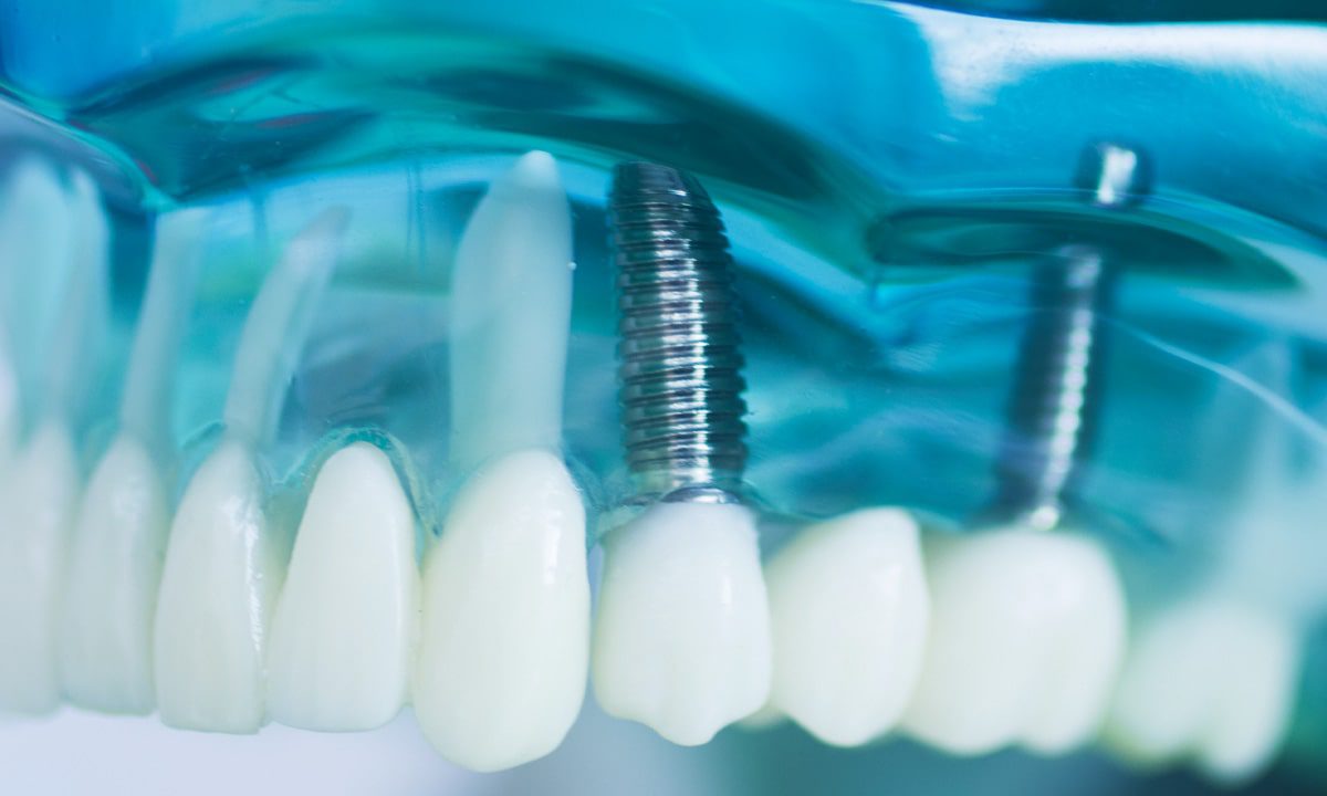 What Are Mini Dental Implants