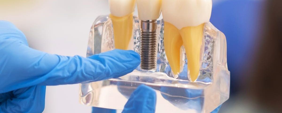 Can a General Dentist Do Implants