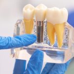 Can a General Dentist Do Implants