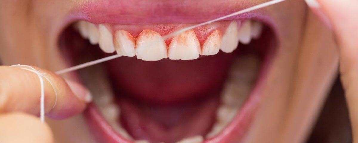 Why Do My Teeth Bleed When I Floss?