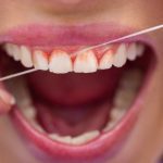 Why Do My Teeth Bleed When I Floss?