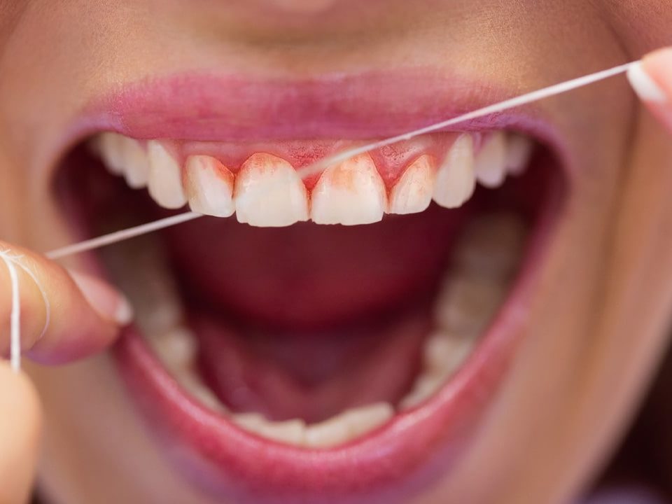 Why Do My Teeth Bleed When I Floss?
