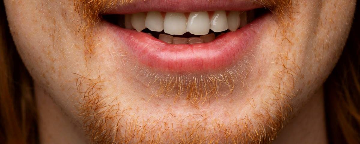 How to Fix Overlapping Teeth?