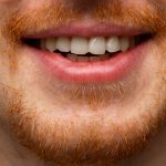 How to Fix Overlapping Teeth?