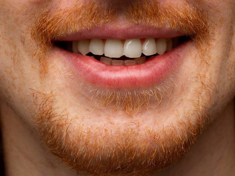 How to Fix Overlapping Teeth?