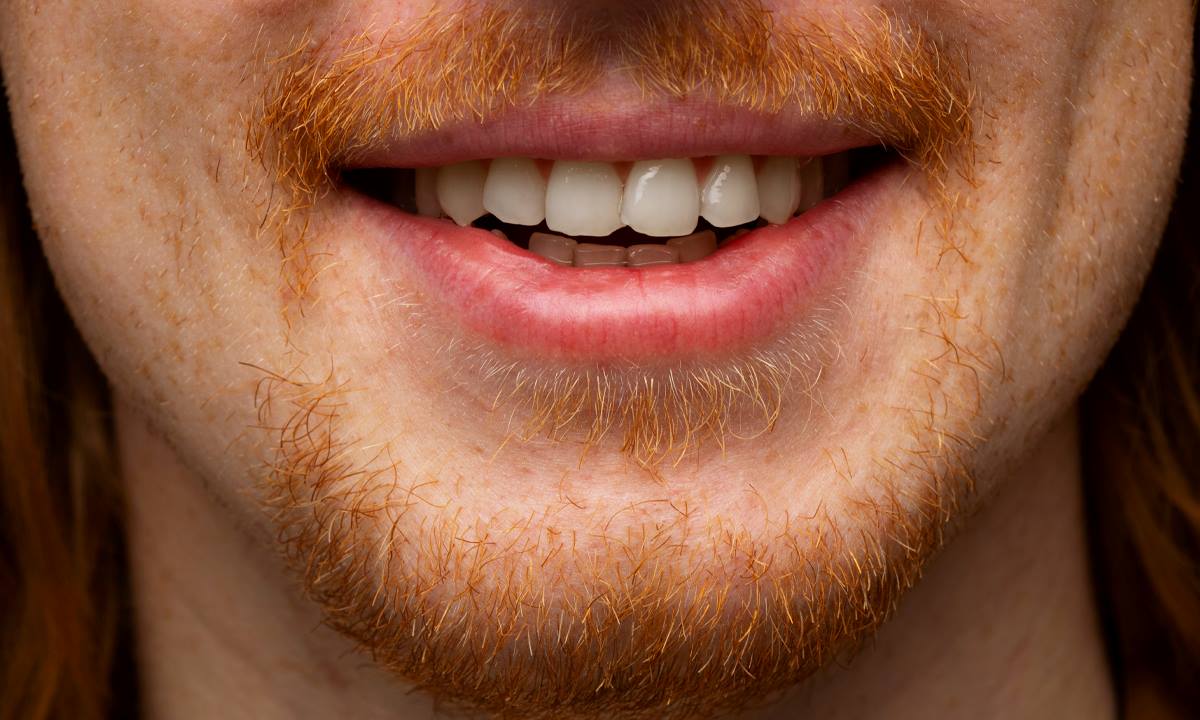 How to Fix Overlapping Teeth?