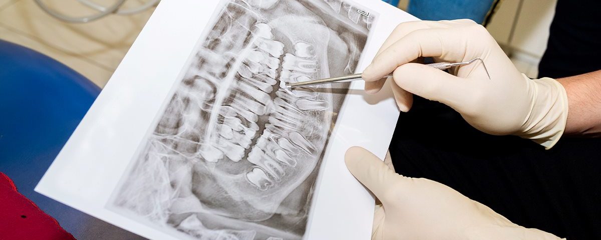 Post-Operative Instructions for Bone Grafting