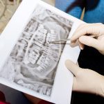 Post-Operative Instructions for Bone Grafting