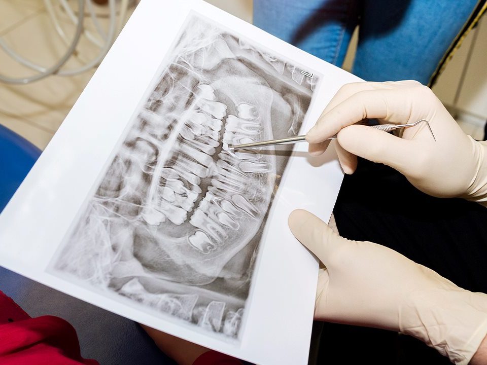 Post-Operative Instructions for Bone Grafting