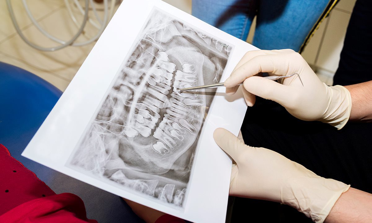 Post-Operative Instructions for Bone Grafting