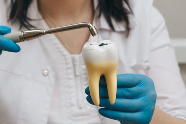 Fillings - Best Dentistry in Rancho Santa Fe, Avondale