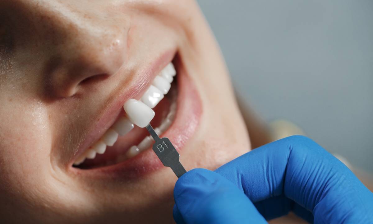 How Strong are Porcelain Crowns