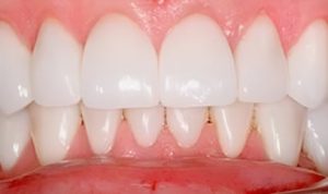Can You Smoke After a Tooth Extraction? | Desert Lake Family Dentistry
