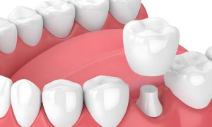 Dental Crowns Complications, Advantages and Disadvantages