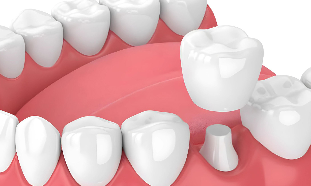 What are the Complications, Advantages, and Disadvantages of Dental Crowns?