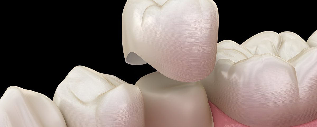 Care for Your Same Day Dental Crown After Placement