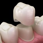 Care for Your Same Day Dental Crown After Placement