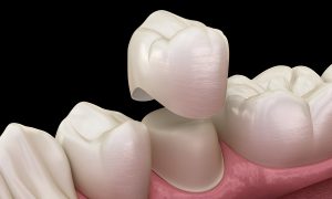 Care for Your Same Day Dental Crown After Placement
