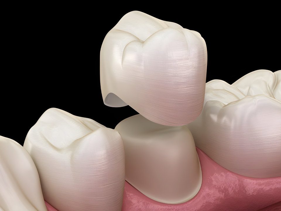 Care for Your Same Day Dental Crown After Placement