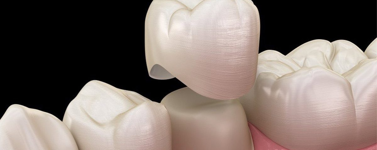 CEREC Crown vs Traditional Crown: Which Is Better for You?