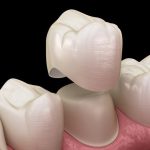 CEREC Crown vs Traditional Crown: Which Is Better for You?