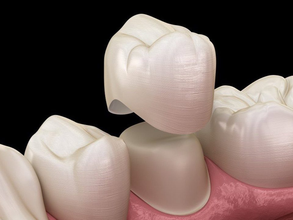 CEREC Crown vs Traditional Crown: Which Is Better for You?