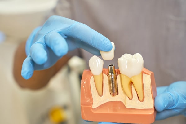 Single Dental Implant - Best Dentistry in Phoenix