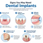 Signs You Need Dental Implants
