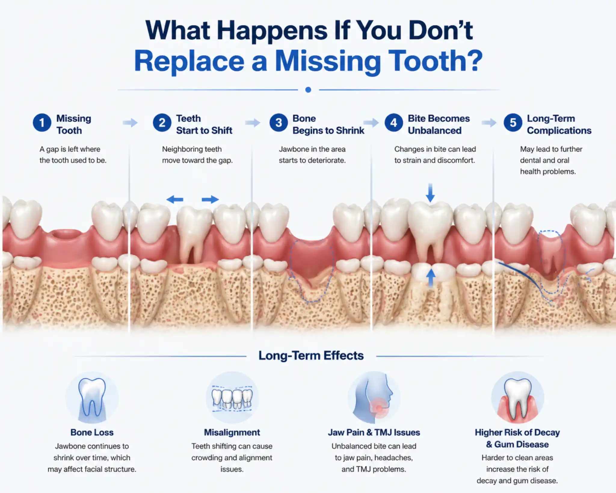 what happens if you do not replace a missing tooth including bone loss shifting teeth and bite problems