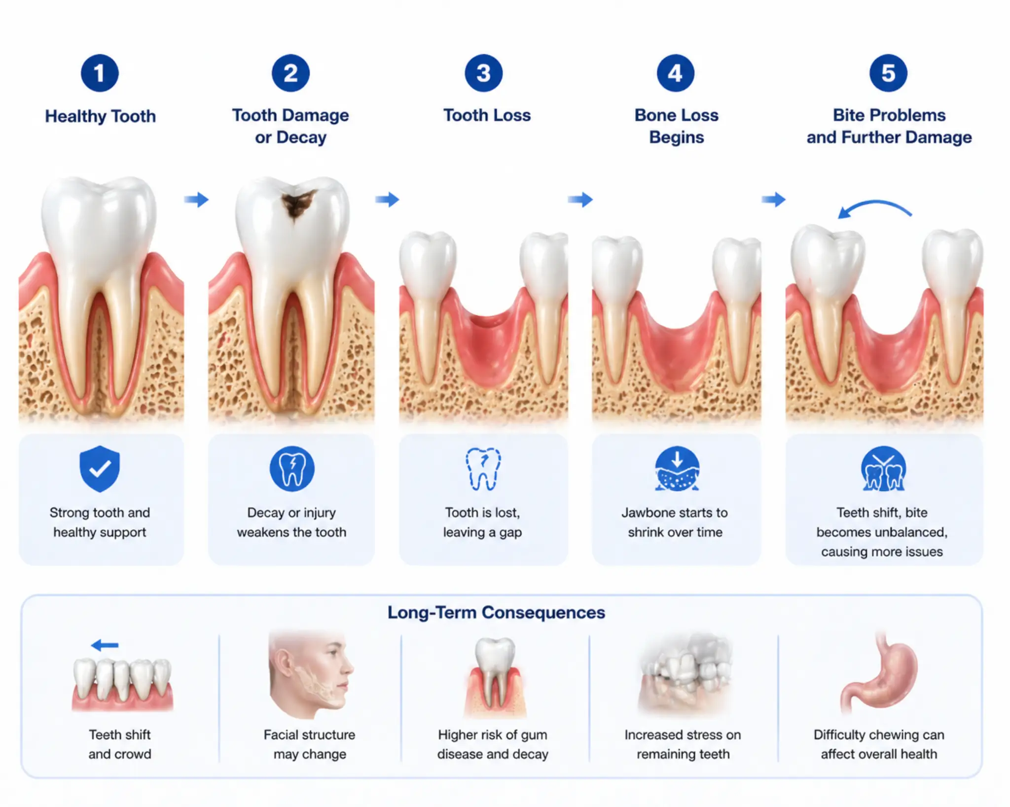 tooth loss progression from healthy tooth to bone loss and bite problems over time