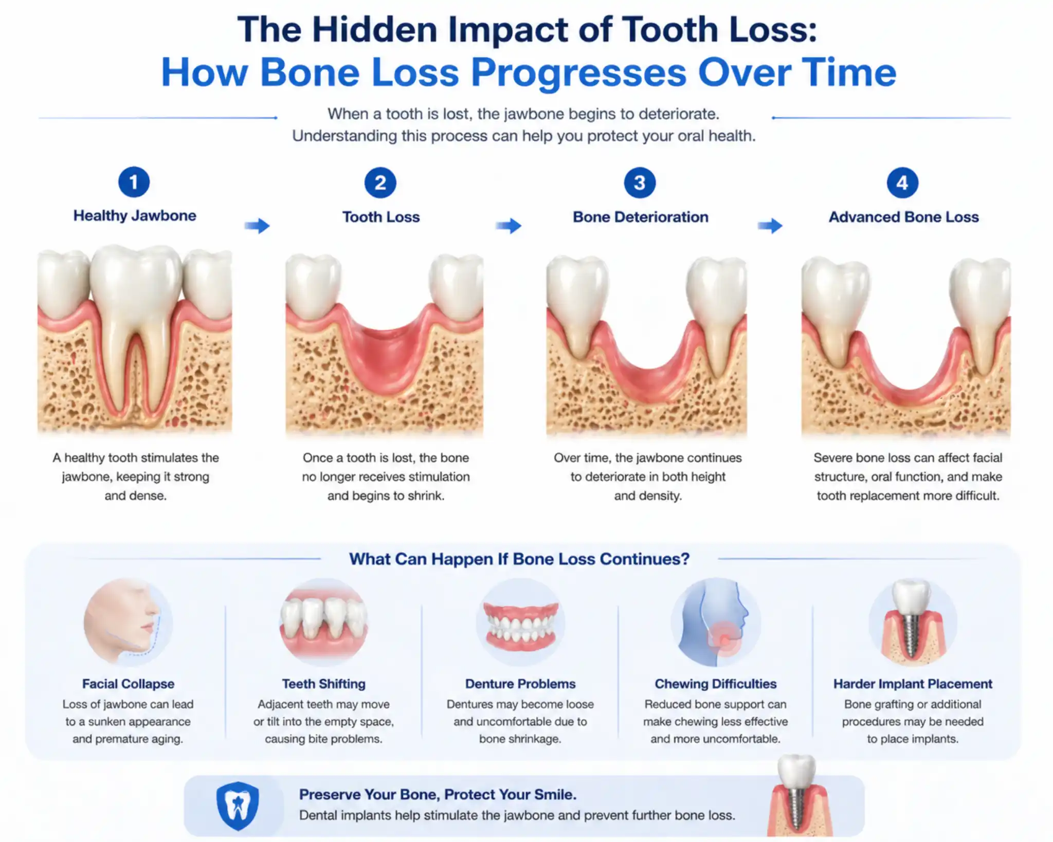 jawbone loss progression after tooth loss and its effect on facial structure and oral health