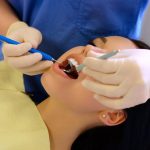 How Long Do Dental Fillings Last?