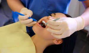 How Long Do Dental Fillings Last?