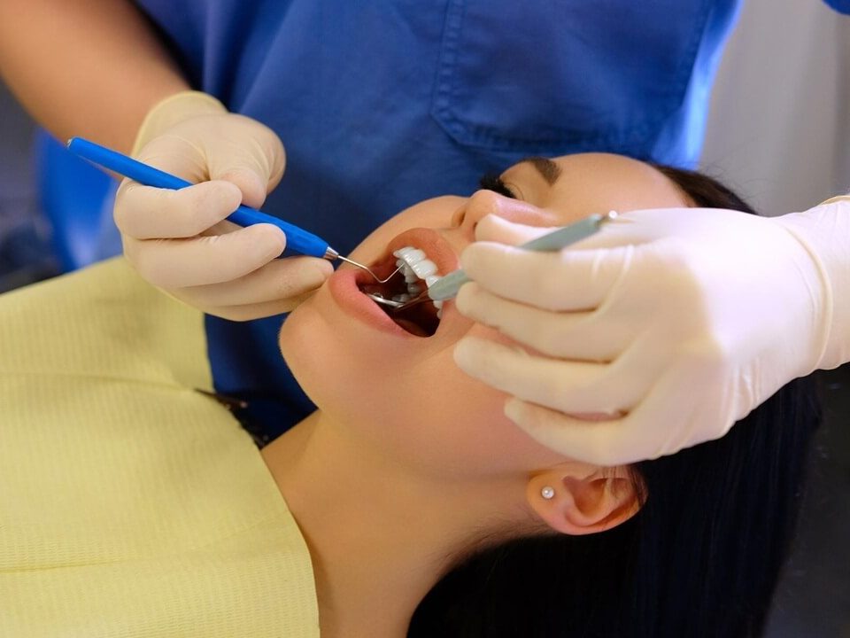 How Long Do Dental Fillings Last?