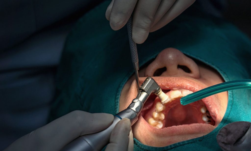 Tooth Extraction Buckeye