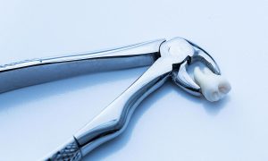 Will an ER Remove a Tooth?