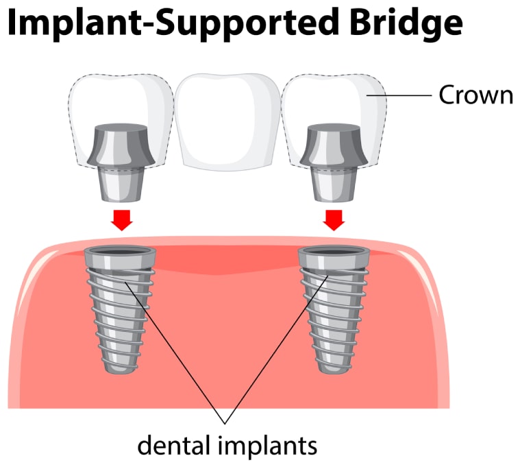 Fixed Implant Bridges