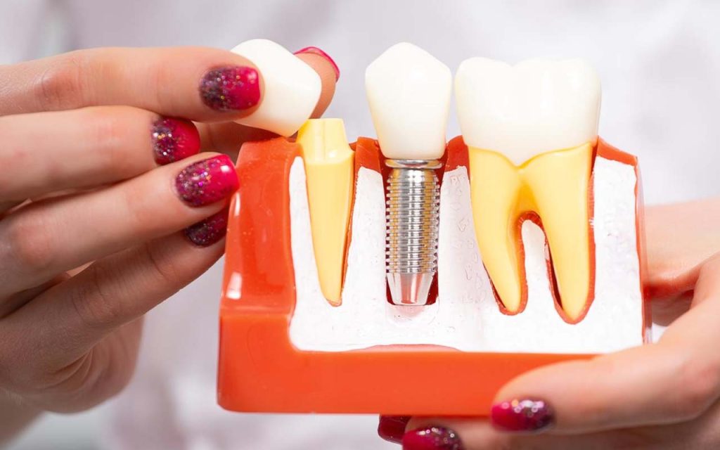 Single Tooth Implant Buckeye, AZ