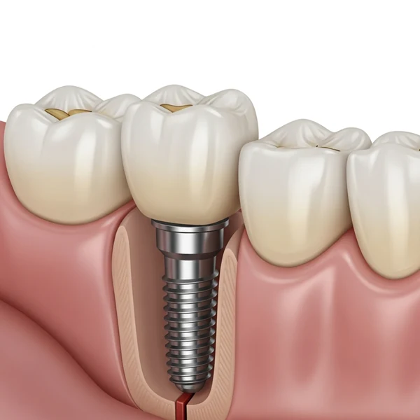 Average Cost of Same Day Dental Implants in Avondale