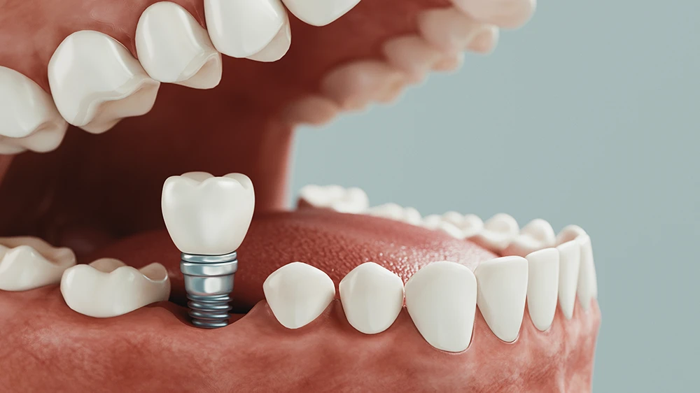Dental Implants Avondale
