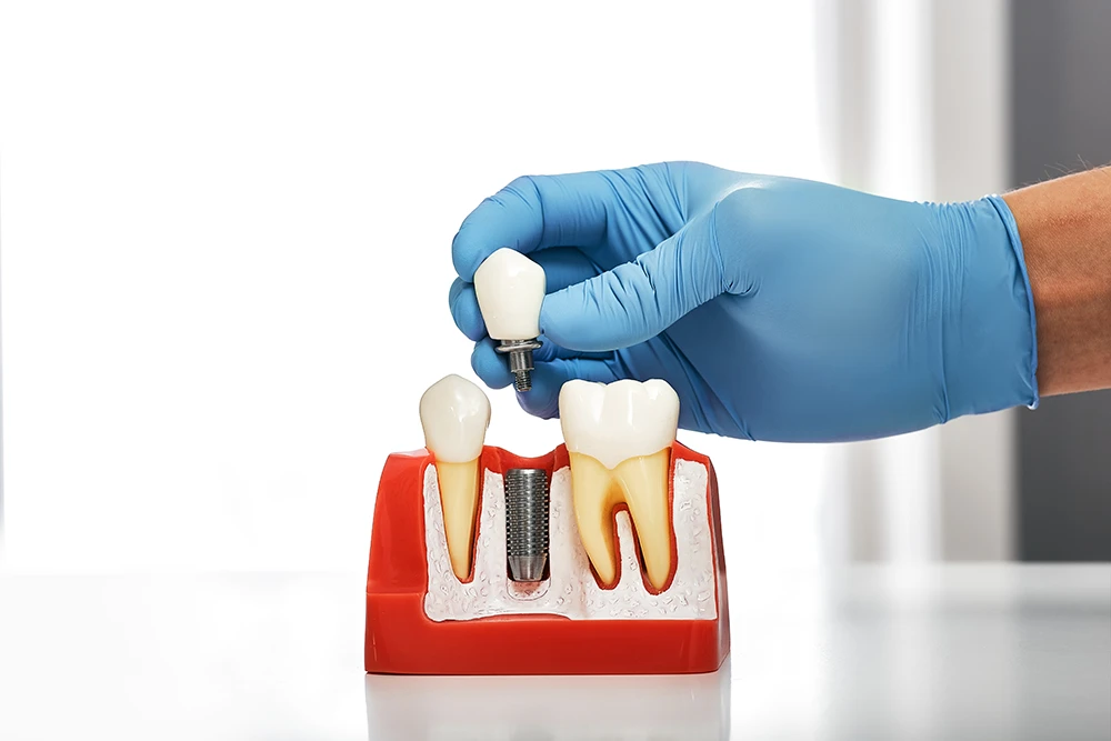 What is a Single Tooth Implant?