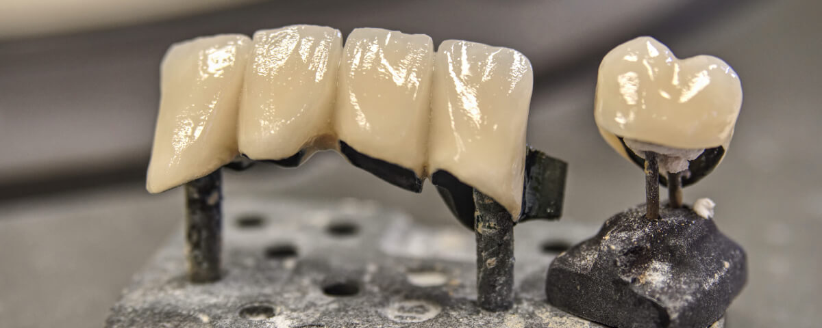 Cost of Porcelain Crown in Avondale, AZ